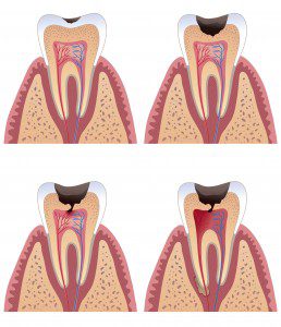 root canal stages